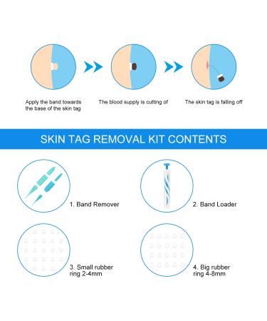 PAIQIU Skin Tag Remover Kit - Effective Tools for 2-4mm & 4-8mm Skin Tags Moles Warts | Facial Care Solution - Buy Online on GoSupps.com