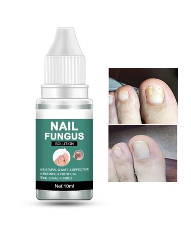Fungal Nail Treatment for Toenail Extra Strong Safety Effective Nail Fungus Solution Ingrown Toenail Treatment Nail Care Oils Anti Toe Toenail Nail Fungal Solution(10ML)