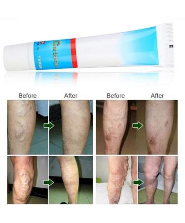 Varicose Vein Treatment Cream - Reduce Inflammation, Improve Circulation | Vein Lotion for Legs & Body - Buy Online on GoSupps.com