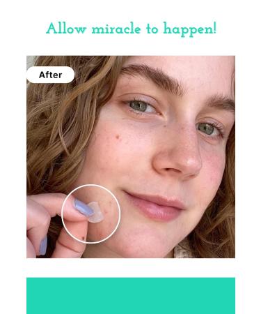 Charli & Beaux Emergency Acne Patches - Fast Effective Spot Treatment for Clear Skin - Buy Online on GoSupps.com