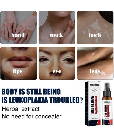 Kolmax Alkyne Psoriasis and Vitiligo Relief Spray - Reduces White Spots on Skin - 3PCS - Buy Online on GoSupps.com