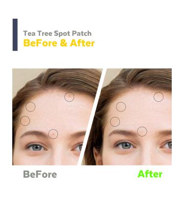 Tea Tree Spot Patch 90 Dots with Salicylic Acid for Acne Blemishes - Invisible Bandaids for Covering Pimples - Face Stickers for Blemish Control - 0.55 Inch Patches - Buy Online on GoSupps.com