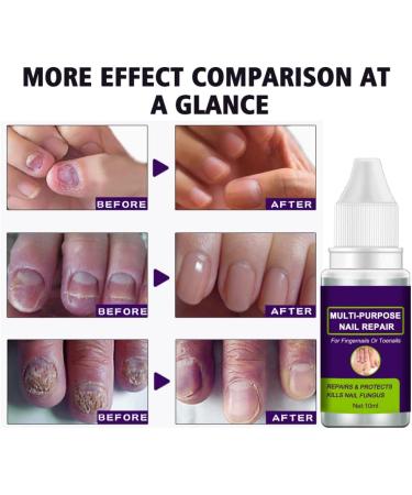 Nail Repair Toenail Care Solution Multi-purpose Renewl Restores Discolored and Damaged Nails 10 ML cracked nail repair gel - Buy Online on GoSupps.com