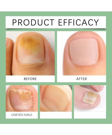 S rum revitalisant pour ongles s rum de soin des ongles au gingembre pour ongles ab m s et cassants renforce les ongles et pr vient les envies prot ge et nourrit hydrate (1pcs) - Buy Online on GoSupps.com