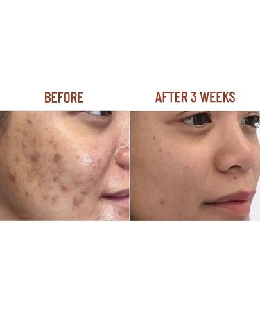 ABERA Nano Turmeric Vitamin C Serum, Nourish and Brighten Skin Tone, Reduce Dark Spots, Acne Bruise Relief, Restore Skin Strength, Skin Care Oil for Face (0.51 Fl Oz) (Set 2) Turmeric Serum 2 - Buy Online on GoSupps.com