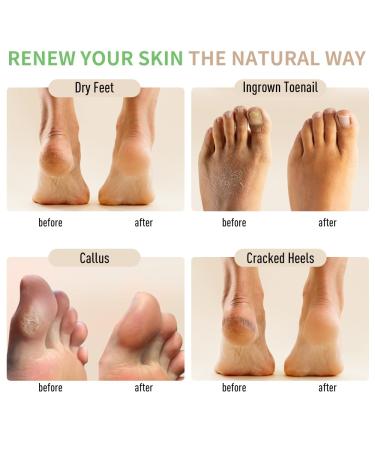 Natural Foot Soak Salt for Athletes Feet - Relieve Odor & Itchiness | 9 Ounce Foot Treatment - Buy Online on GoSupps.com