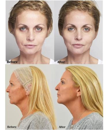 Fils de Soie de collag ne pour Fil de Soie Lifting de Fil de Soie pour Le resserrement de la Peau collag ne Actif pour Le Visage Fils de Soie Lifting et renforcent efficacement la Peau du Visage - Buy Online on GoSupps.com