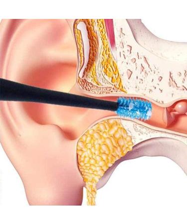 Waitlover Ear Wax Removal Kit - Ear Pick Cleaning Tool for Healthier Ears - Buy Online on GoSupps.com