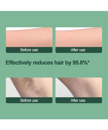 Yeeda Crystal Hair Eraser - Painless Hair Removal Tool for Arms & Legs | Upgrade Your Crystal Hair Eraser for Effortless Exfoliation & Smooth Skin - Buy Online on GoSupps.com