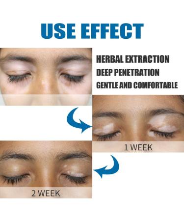 USLEAN Kolmax Vitiligo Soothing Ointment 20g - Psoriasis and Vitiligo Cream for All Skin - Buy Online on GoSupps.com