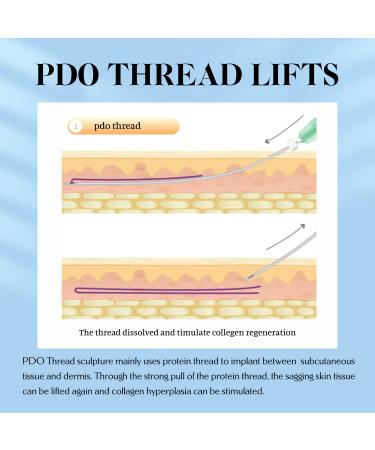 PDO Cog Threads for Face & Body Lift 90mm Sharp 3D Threads (10 Pieces) - Enhance Your Beauty - Buy Online on GoSupps.com