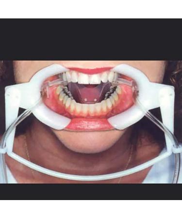 Oiakus orthodontic saliva expansion mouth opener dental cheek holder with saliva suction device tongue protection for orthodontic tooth whitening.Large