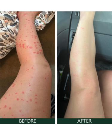 Sorted Skin Intensive Rescue Spray for Dry Dehydrated & Sensitive Skin to Help Soothe & Nourish Itchy Skin Relief with Prebiotic Ingredients 100ml - Buy Online on GoSupps.com