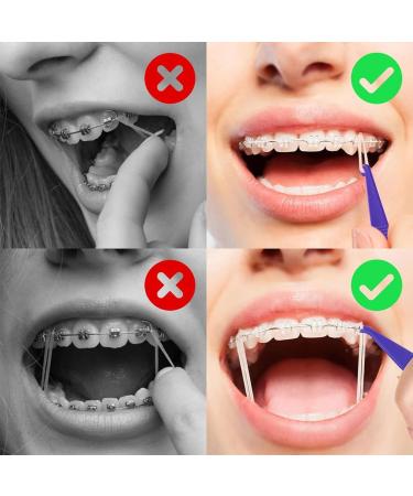 15 PCS Orthodontic Wax for Braces - Relieve Irritation & Pain | Includes 20 Tooth Elastic Inserts - Buy Online on GoSupps.com