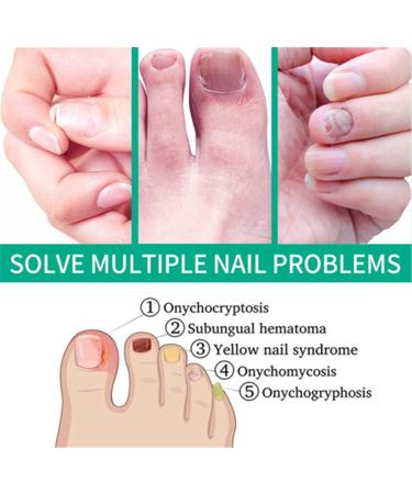 Fungus Treatment Oil Foot Fungus Oil Kerasentials Nail Treatment Healthy Natural Repair Nails Natural Toenail for Damaged & Discolored Toe Nails (2pcs) - Buy Online on GoSupps.com