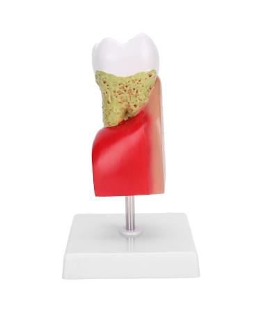Verdant Touch Tooth Model Dental Caries Tooth Model for Teaching Training Patient Education