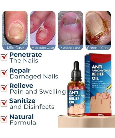 (100% Effective) KYOSK 10ml German Anti Paronychia Relief Oil Anti Paronychia Relief Oil Treatment Repair Paronychia Improve Toenail Health (3pcs) - Buy Online on GoSupps.com