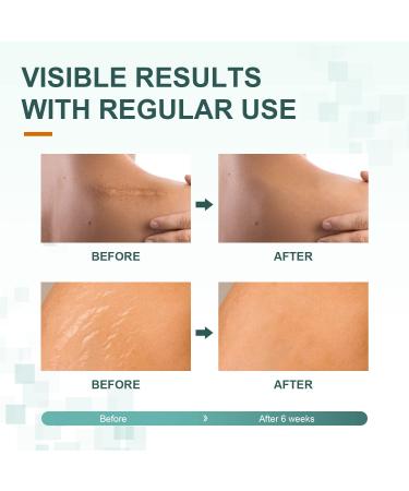 FUNNIR Silicone Scar Sheets 6 Pack - Healing C-Section and Tummy Tuck Keloid Scars - Surgical Cream Gel Patch Bandage - 5.7x1.57 - Buy Online on GoSupps.com