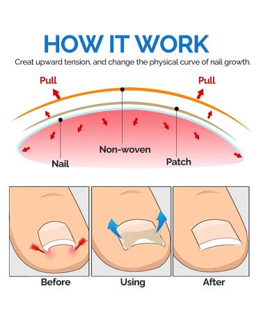 Glue-Free Ingrown Toenail Corrector Patch - 50 Pcs | Treatment Tool for Ingrown Toenails - Buy Online on GoSupps.com