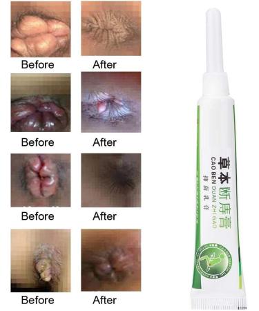 Semme Hemorrhoids Ointment Cream - Fast Relief for Internal & External Piles, Anal Fissure (1 Pack) - Buy Online on GoSupps.com