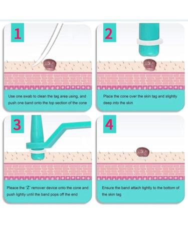 77PCS Skin Tag Remover Patches for 2-5mm Skin Tags - Green Skin Tag Removal Kit - Buy Online on GoSupps.com
