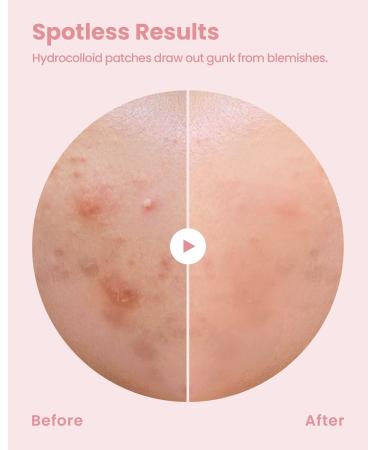 Glam Up Hydrocolloid Blemish Pimple Zit Patches - 72 Count, Invisible Ultra-Thin Spot Cover Stickers for Face, Strong Water-Proof, Vegan-Friendly - Buy Online on GoSupps.com