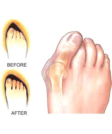 16Pcs Gel Toe Spacers & Bunion Corrector for Men and Women | Toe Separators Pads - Buy Online on GoSupps.com