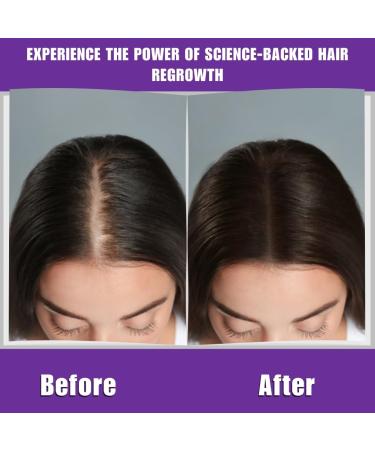 Buy Anti-Hair Loss Shampoo #2 - MCB Biotechnology & Silk Spider Formula | 11 Oz | International Shipping Available - Buy Online on GoSupps.com