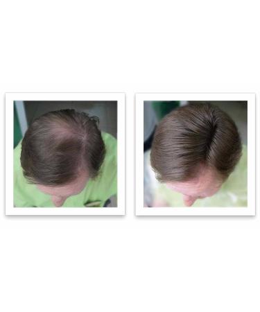 Caboki All-Natural Hair Building Fiber | Hair Loss Concealer for Bald Spots and Thinning Hair (Medium Brown) - 40-Day Supply - Buy Online on GoSupps.com