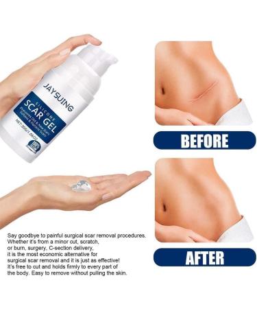 Silicone Skin Renewal Gel - Women's Treatment for Surgical Scars, Stretch Marks, Acne, Burn Scars & Pockmarks - 1pcs - Buy Online on GoSupps.com