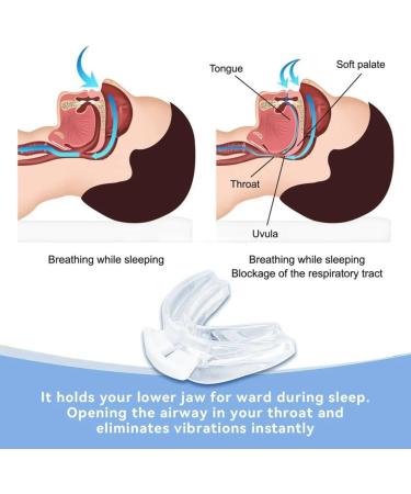 Anti Snoring Device Anti Snoring Mouth Guard Snoring Solution Stop Snoring Devices Anti Snoring Mouthpiece Mouth Guard for Snoring Night Guard for Teeth Grinding Snore Guard Comfortable Sleep - Buy Online on GoSupps.com