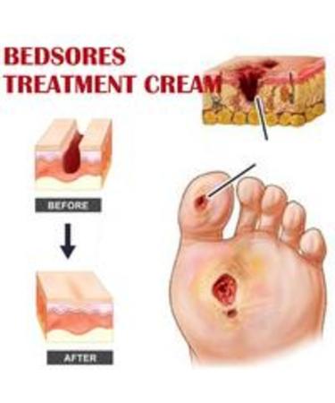 Bedsor_e Wound Care Cream SOR_ess Relief Healing Cream 20g Bedsor_e Ointment for Fast Healing Soothing Relief of Bed SOR_ess Chafed Skin Hard-to-Heal Skin SOR_ess Wound Healing - Buy Online on GoSupps.com