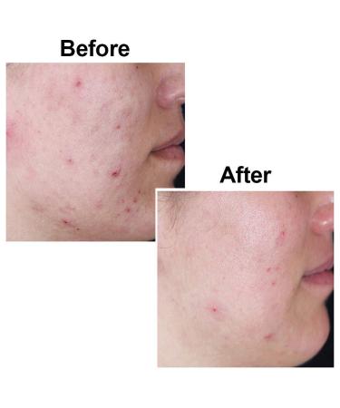 Kojie San Skin Lightening Kojic Acid Soap - 5 Pack, 2 Bars 65g - Super Savings - Buy Online on GoSupps.com