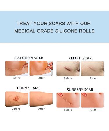 Medical Grade Scar Removal Silicone Tape (1.6x60 Roll) for Hypertrophic Scars & Keloids | Surgery, Injury, Burns, C-Section Crease | 2 Rolls - Buy Online on GoSupps.com