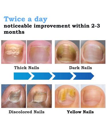 Nail Fungus Laser Treatment Device - Effective Home Therapy for Damaged Nails - 910nm Infrared & 470nm Blue Light - Buy Online on GoSupps.com