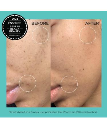 Urban Skin Rx Advanced Even Tone Day & Night Treatment 1.7 oz | Fade Dark Spots, Acne Scars & Hyperpigmentation with 3% Tranexamic Acid & 5% Niacinamide - Buy Online on GoSupps.com