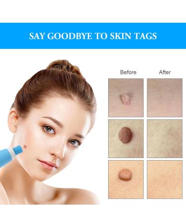 ACWOO Wart Remover & Skin Tag Removal Kit - Effectively Remove Warts 2mm-8mm for All Body Parts - International Shipping Available - Buy Online on GoSupps.com