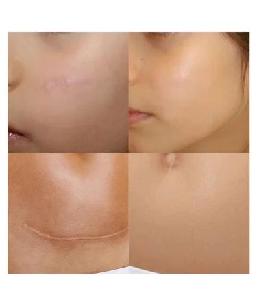 Tummy Scars Care Cream - Easy to Use 15Pcs Scar Removal Cream for Burn & Small Wounds - Buy Online on GoSupps.com