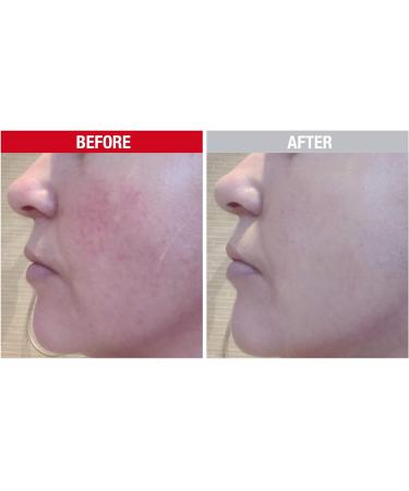 Altruist Dermatologist Anti Redness and Pigmentation SPF50 Tinted Face Cream Unscented 30 ml (Pack of 1) Anti Redness & Pigmentation - Buy Online on GoSupps.com