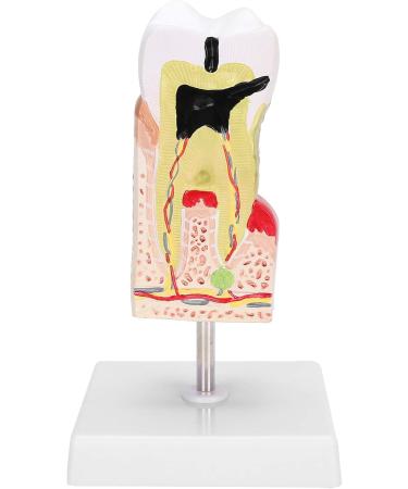 Verdant Touch Tooth Model - Dental Caries Teaching & Training Aid for Patient Education - International Shipping - Buy Online on GoSupps.com