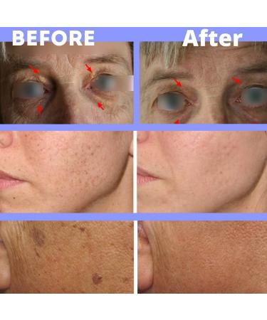 XanthRemover 70% Glycolic Acid Peel Gel | Improve Xanthelasma, Brown Spots, Dark Spots | Upper Eyelid Tightening | Anti-Aging Treatment - Buy Online on GoSupps.com