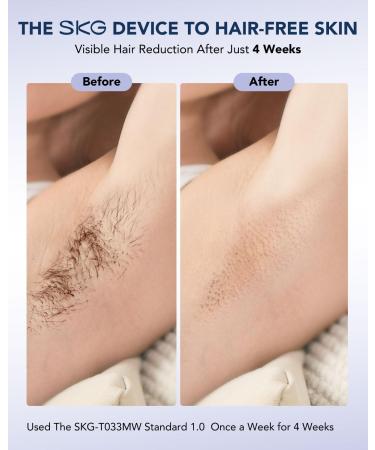 SKG Laser Hair Removal Device - Painless IPL Technology for Men & Women | Infinite Flashes & 25-Minute Rapid Results - Buy Online on GoSupps.com