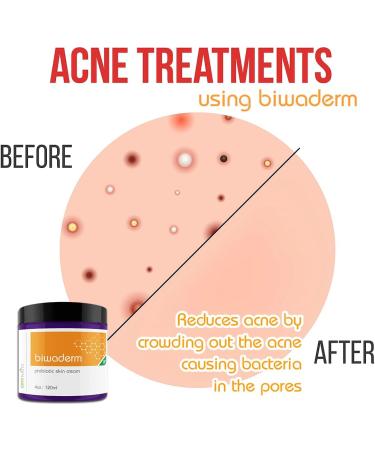 Biwaderm Probiotic Skin Cream - Organic 4oz for Eczema Psoriasis & Folliculitis Treatment with Pure Aloe Vera Gel - Buy Online on GoSupps.com