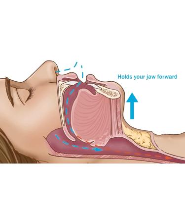 Dentemp SleepTight Mouthpiece - Custom Fit Anti-Snoring Device for Better Sleep | Made in USA - Buy Online on GoSupps.com