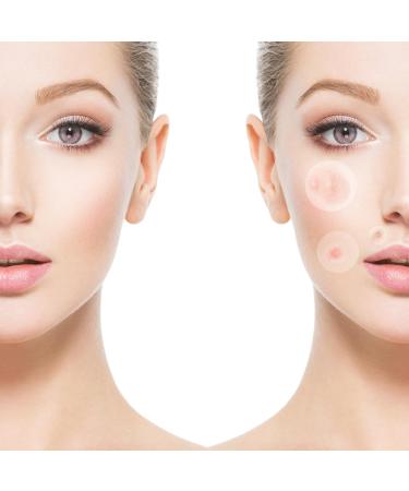 VONKMATT Acne Patches 180 Pcs | Invisible Spot Treatment Stickers | Anti-Acne Dots for Pimples | Skin Care Solution - Buy Online on GoSupps.com