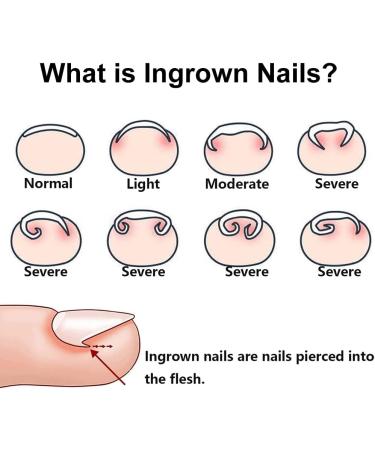 Corrective for Ingrown Nails Correction of Ingrown Nails Correction Kit 30 Pieces Correction Strips for Ingrown Nails Toe Nail Correction - Buy Online on GoSupps.com