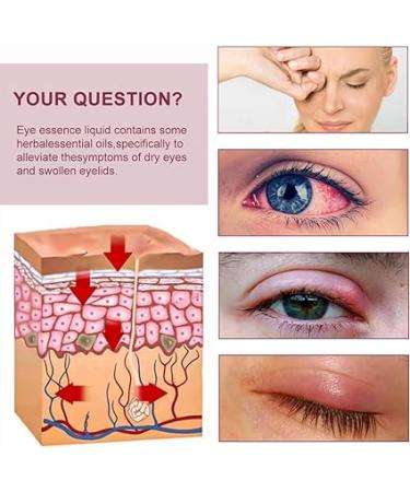 Eye Stye Remover for Fast Relief - Gentle Treatment for Styes  Chalazion  and Blepharitis - Buy Online on GoSupps.com