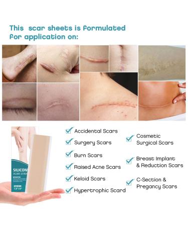 Silicone Scar Strips 1.6''x6'' - 4 pcs Multi-Use Scar Removal Cream (2 Month Supply) - Reusable Scar Tape - Flesh Color - Buy Online on GoSupps.com