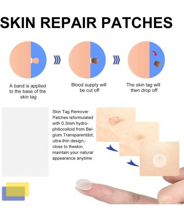 2-in-1 Skin Tag & Mole Remover Kit - Safe & Painless Removal for 2mm-8mm Sized Tags - Easy DIY at Home Green - Buy Online on GoSupps.com