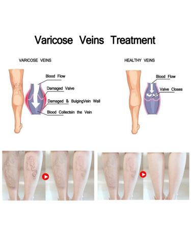 Varicose Veins Cream - Treatment for Legs | Improve Blood Circulation | Natural 50g/1.76oz - Buy Online on GoSupps.com